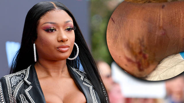 Megan Thee Stallion slams 'lying' accusations with gunshot wound photo
