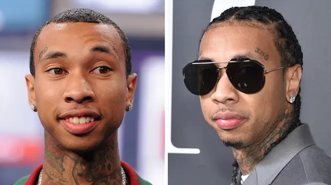 Tyga hairline transplant: Before and after photos, surgery, makeover