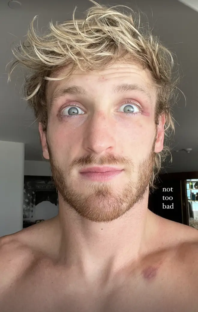 Logan Paul shares photo of his face following his fight with Floyd Mayweather.