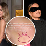 Khloe Kardashian reveals she underwent surgery to remove tumour on her face