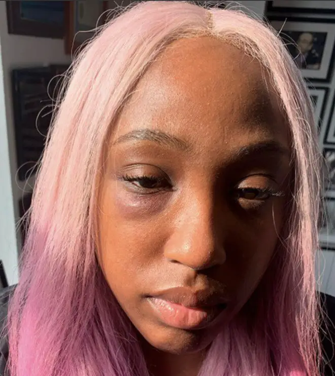 Brittney Taylor takes to social media to reveal a graphic image of her black eye