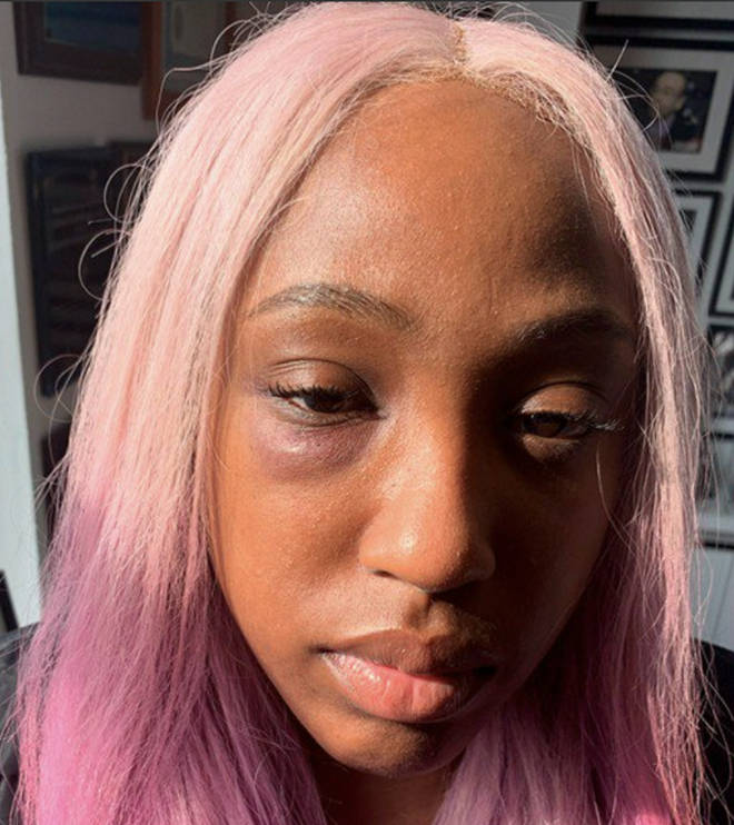 Brittney Taylor took to Instagram to show the public her black eye that allegedly came from Remy Ma punching her in the face.