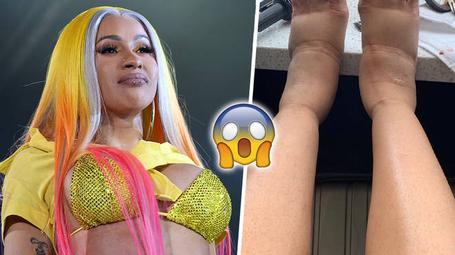 Cardi B has been suffering major cosmetic surgery complications