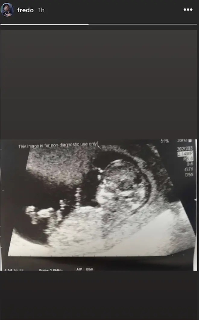 Fredo uploaded the baby scan to Instagram